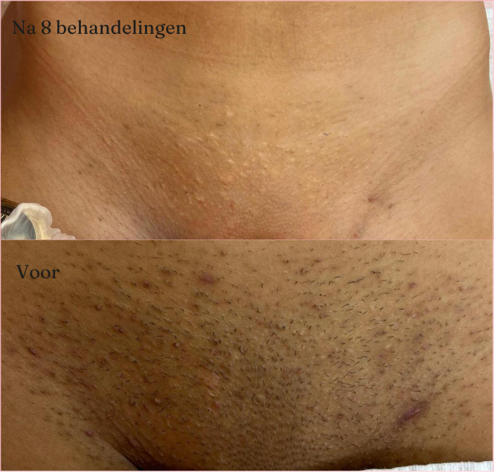 Laserontharing Grace Luxury Wax