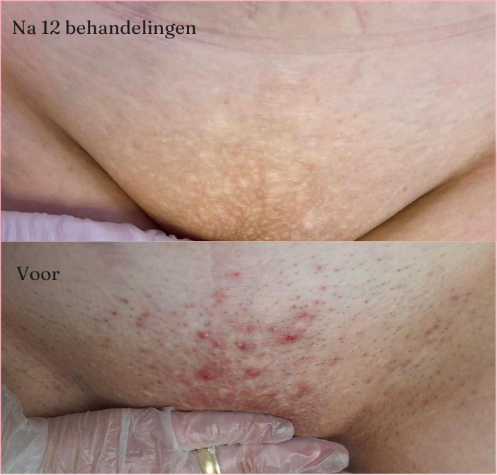 Laserontharing bij Grace